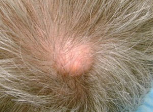 Лечение атером на волосистой части головы лучше проводить именно радиоволновым способом