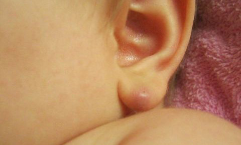 Если атерома развилась на ухе, то лучше применять радиоволновой способ лечения