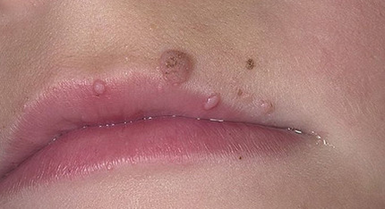 У человека может появляться несколько бородавок на губе сразу, что свидетельствует о серьезных патологиях