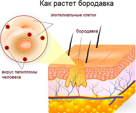 Локализуясь в толще кожи, вирус внедряется в окружающие клетки эпидермиса и размножается, заставляя клетки расти, углубляясь внутрь и выступая над кожей.