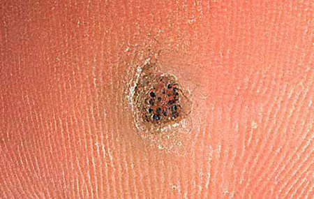 Часто внутри шипицы можно увидеть черные точки, являющиеся закупоренными кровеносными сосудами