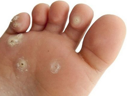 Бородавка чаще всего наблюдается на подошве ног и ладонях. Именно эти части тела характеризуются особенно плотной кожей – оптимальной средой для активизации вируса папилломы.