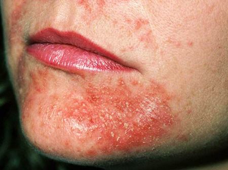 Высыпания могут появиться на любых участках тела: руках, ногах, лице, естественных складках, а также в местах контакта кожи с аллергеном