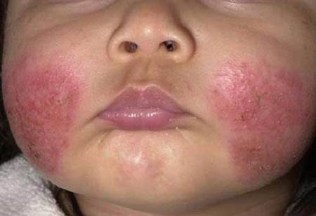 Характерные высыпания на щеках ребенка при атопическом дерматите
