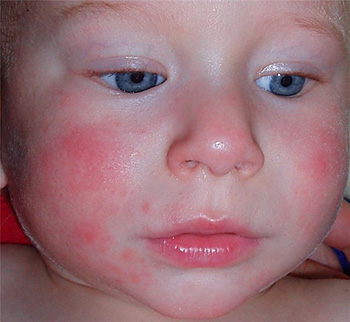 Чаще всего болезнь диагностируется у младенцев, когда иммунная и нервная системы еще плохо сформированы