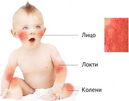 У младенцев чаще всего очаги аллергического дерматита локализуются на сгибах конечностей и на лице