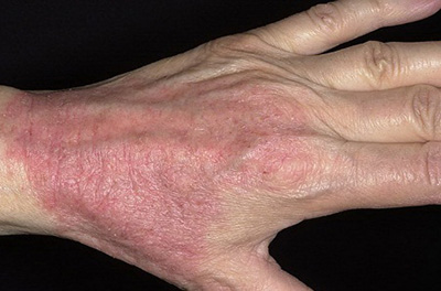 Проявления дерматита изначально фиксируются в местах контакта кожи с аллергеном