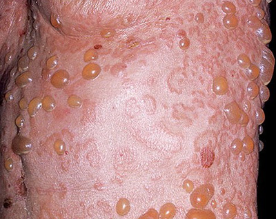 Крупнопузырная форма дерматита