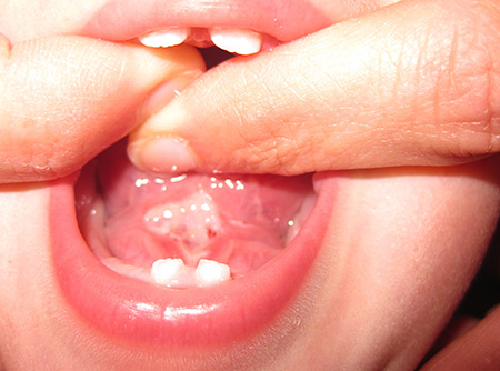 Нередко появляются пузыри на слизистой рта