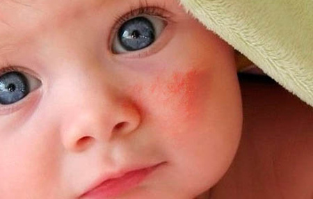 У младенцев болезнь чаще всего поражает кожу лица