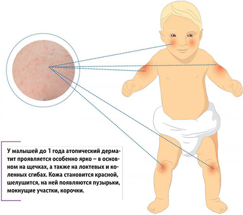 Данный вид дерматита диагностируется в большинстве случаев у малышей в раннем возрасте и у пациентов до 20 лет