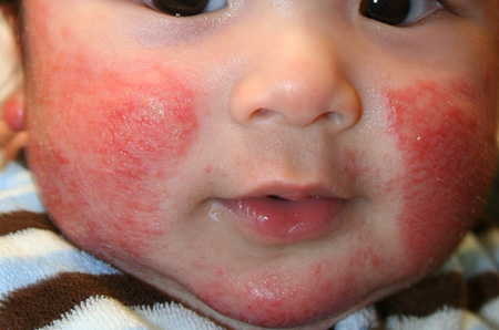 В большинстве случаев АД диагностируется у малышей, родители которых являются аллергиками