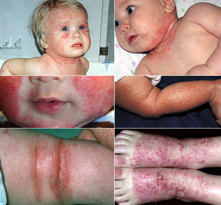 Атопический дерматит – распространенный воспалительный процесс кожных покровов, который может иметь различную локализацию