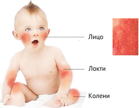 Типичные области поражения кожи при атопическом дерматите