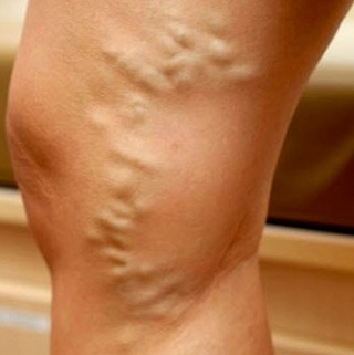 Расширение вен – частая причина дерматита на ногах