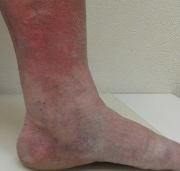 Застойный дерматит развивается при болезнях вен ног