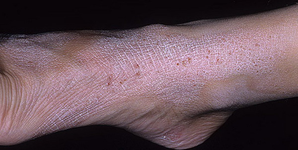 Нейродермит на ногах отличается сухостью кожи и наличием трещин