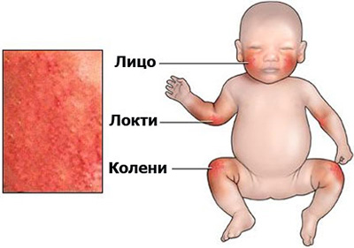 Типичная локализация высыпания при атопическом дерматите у новорожденного