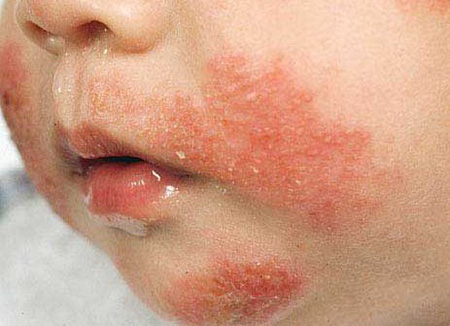 При эксфолиативном дерматите первые проявления возникают вокруг рта