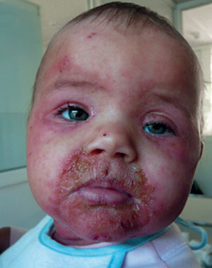 У детей более старшего возраста дерматит Риттера протекает легче, однако и он сопровождается поражениями кожи