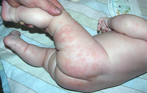 Типичное расположение пеленочного дерматита – на коже паховых складочек, ягодиц, промежности