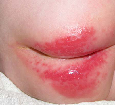 Проявление дерматита у детей является результатом использования подгузников и нарушения гигиены зоны промежности
