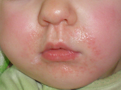 Особенность периорального дерматита заключается в появлении раздражения кожи исключительно в околоротовой области
