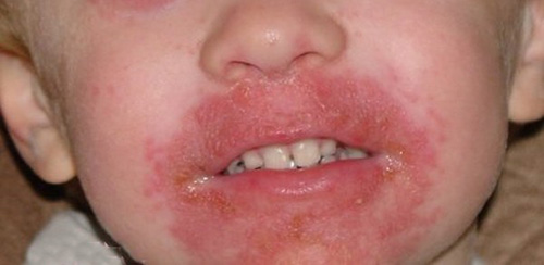 Пероральный дерматит проявляется образованием разнородных высыпаний вокруг рта