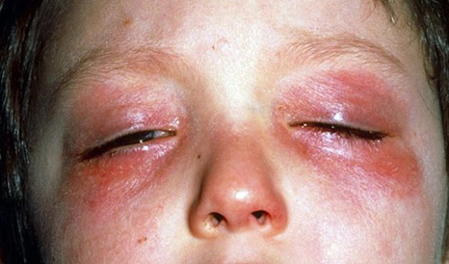 Периорбитальная форма дерматита опасна для глаз