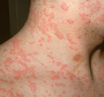 Сыпь может располагаться на самых разных участках кожи