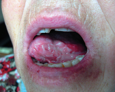 Пузырьковый дерматит на слизистой рта