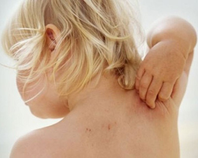 Для появления дерматита у ребенка нужны провоцирующие факторы