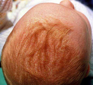 Себорейный дерматит нужно лечить в первые месяцы жизни малыша