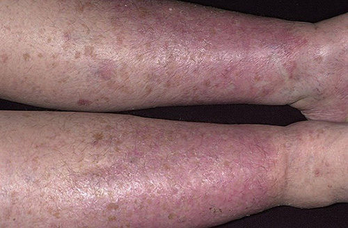 Типичный варикозный дерматит с цианозом и пигментацией кожи голеней