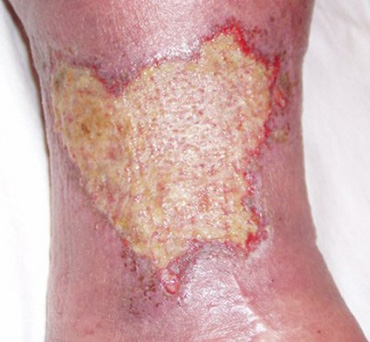 Трофическая язва голени на фоне варикозного дерматита