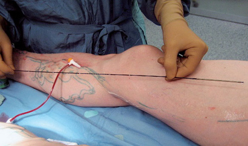 Операция лазерного удаления вен не оставляет рубцов на коже
