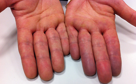 Посинели пальцы на руках – это может быть как симптом перемерзания, так и признак серьезной патологии