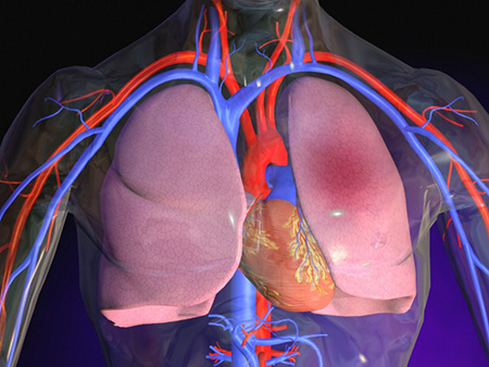 Не только пороки сердца, но и серьезные патологии легких могут стать причиной развития акроцианоза