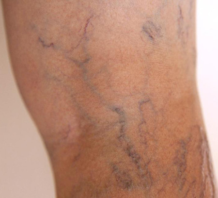 Варикозная болезнь развивается по причине нарушения кровообращения в сосудах ног; естественно, цвет кожных покровов будет меняться