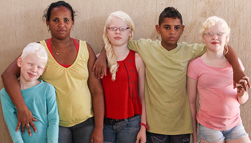 В мексиканской семье родились дети, больные альбинизмом и совершенно здоровые