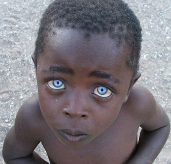 При глазном альбинизме меланин отсутствует только в радужной оболочке глаза
