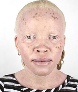 У афроамериканцев, подверженных такому типу расстройства, на открытых участках кожи под воздействием солнечных лучей появляются веснушки и пигментные пятна