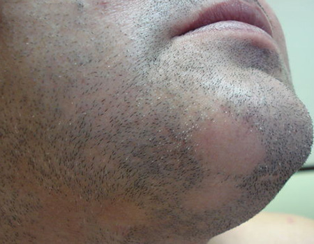 При гнездной алопеции залысины появляются не только на волосистой части головы, но и на лице (борода, усы)