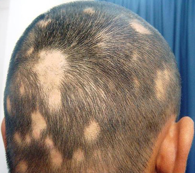 Очаговая алопеция – один из самых распространенных видов. Волосы начинают восстанавливаться после устранения первопричины