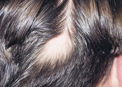 В 95% случаев облысения у мужчин причиной потери волос становится андрогенная алопеция