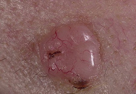 Так выглядит патологическое новообразование при базальноклеточном раке кожи