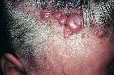 Базалиома Шпиглера, которая также известна как цилиндрома. Новообразования локализуются в волосистой части головы.