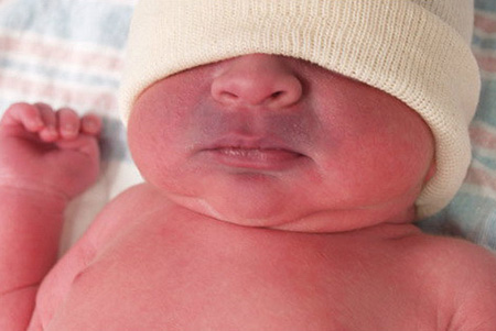 У новорожденных синий оттенок кожи может быть спровоцирован слишком близким расположением венозных сосудов