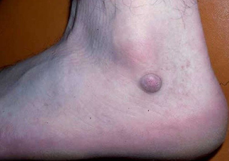 Дерматофиброма чаще всего появляется на ноге, и ее размер не превышает нескольких см.
