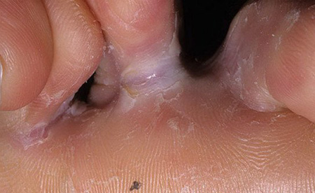 Дерматофития стоп часто сочетается с грибковым поражением ногтевых пластин
